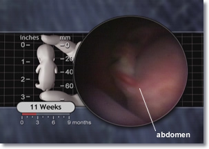 11 weeks Fetus, intestines, abdomen