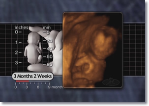 3 Month Fetus 3D Ultrasound