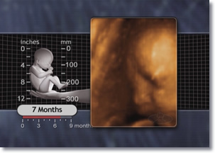 3D Ultrasound of 7 month fetus