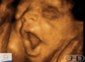 4D Ultrasound