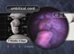 Close-Up of Umbilical Cord