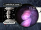 Closeup Umbilical Cord at 7�  Weeks