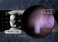 Genital Tubercle 9 Weeks, 2 Days