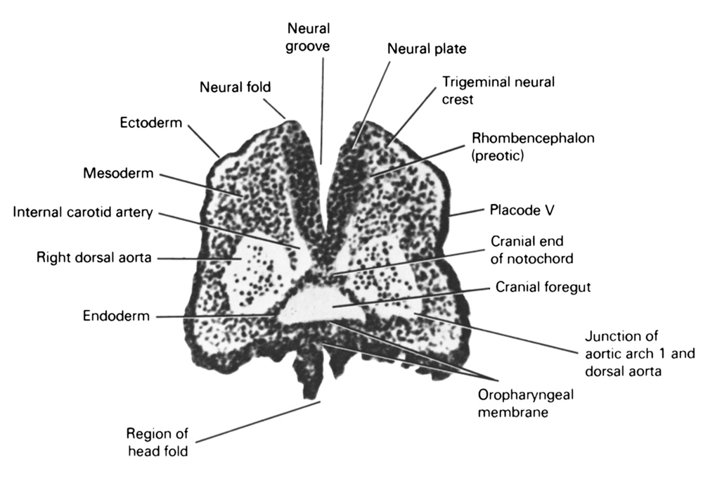 interrupted aortic arch neural crest