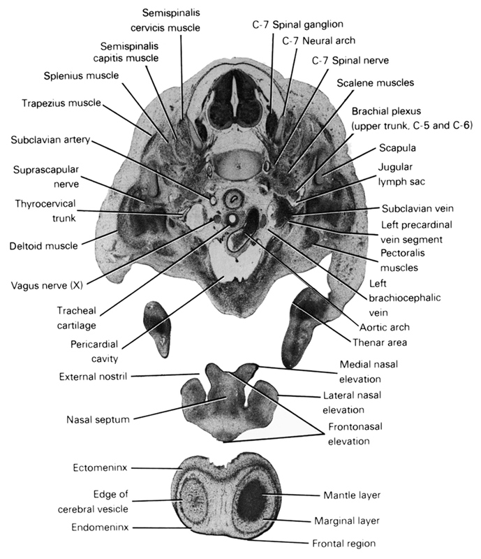 C-7 neural arch, C-7 spinal ganglion, C-7 spinal nerve, arch of aorta, brachial plexus (upper trunk, C-5 and C-6), deltoid muscle, ectomeninx, edge of cerebral vesicle(s), endomeninx, external nostril, frontal region, frontonasal elevation, jugular lymph sac, lateral nasal elevation, left brachiocephalic vein, left precardinal vein segment, mantle layer, marginal layer, medial nasal elevation, nasal septum, pectoralis muscles, pericardial cavity, scalene muscles, scapula, semispinalis capitis muscle, semispinalis cervicis muscle, splenius muscle, subclavian artery, subclavian vein, suprascapular nerve, thenar area, thyrocervical trunk, tracheal cartilage, trapezius muscle, vagus nerve (CN X)