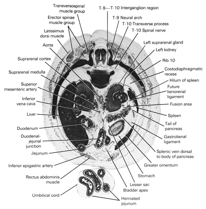 T-10 spinal nerve, T-10 transverse process, T-9 / T-10 interganglion region, T-9 neural arch, aorta, apex of urinary bladder, costodiaphragmatic recess, duodenal jejunal junction, duodenum, erector spinae muscle group, fusion area, future lienorenal ligament, gastrolienal ligament, greater omentum, herniated jejunum, hilum of spleen, inferior epigastric artery, inferior vena cava, jejunum, latissimus dorsi muscle, left kidney, left suprarenal gland, lesser sac, liver, rectus abdominis muscle, rib 10, spleen, splenic vein dorsal to body of pancreas, stomach, superior mesenteric artery, suprarenal cortex, suprarenal medulla, tail of pancreas, transversopinal muscle group, umbilical cord