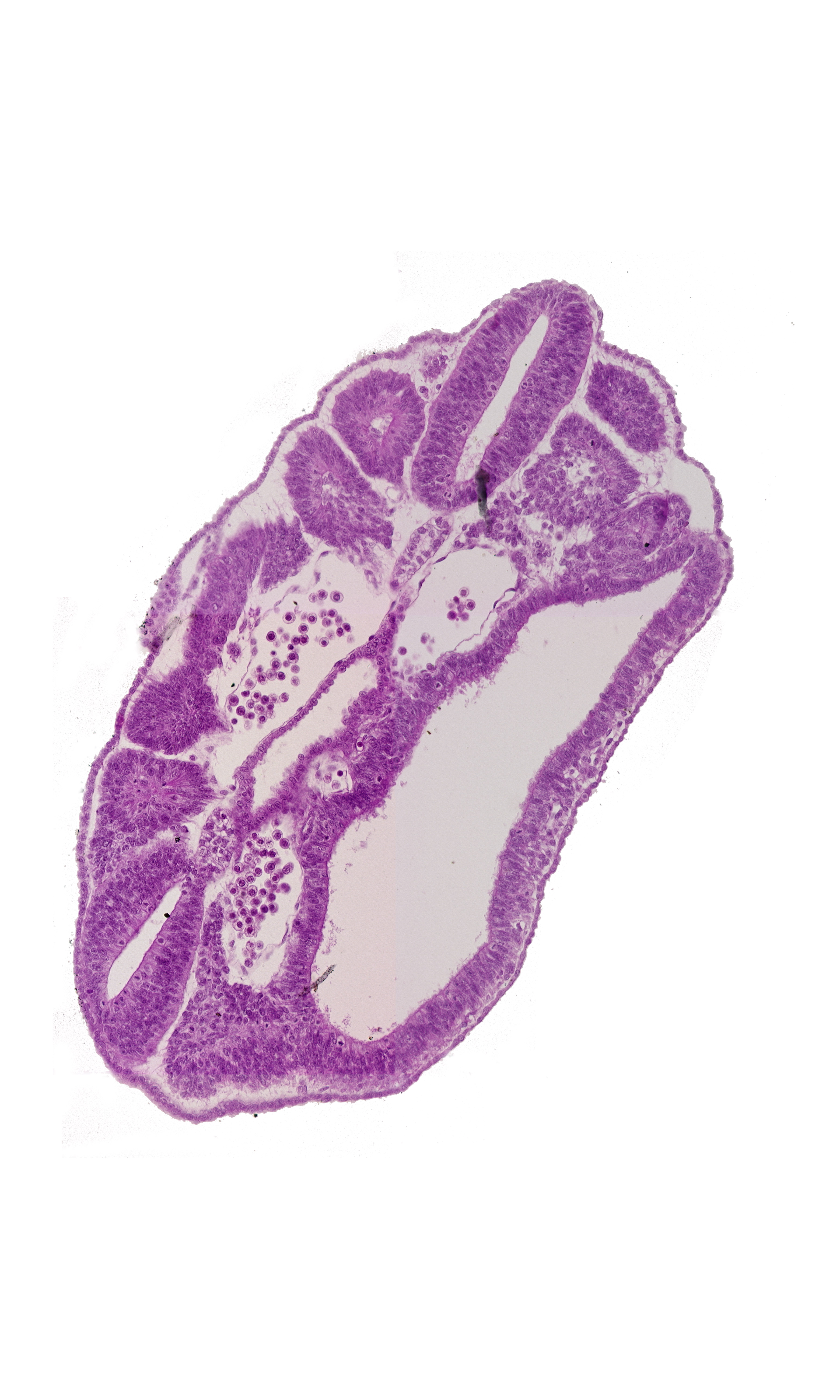 jelly belly pseudomyxoma peritonei