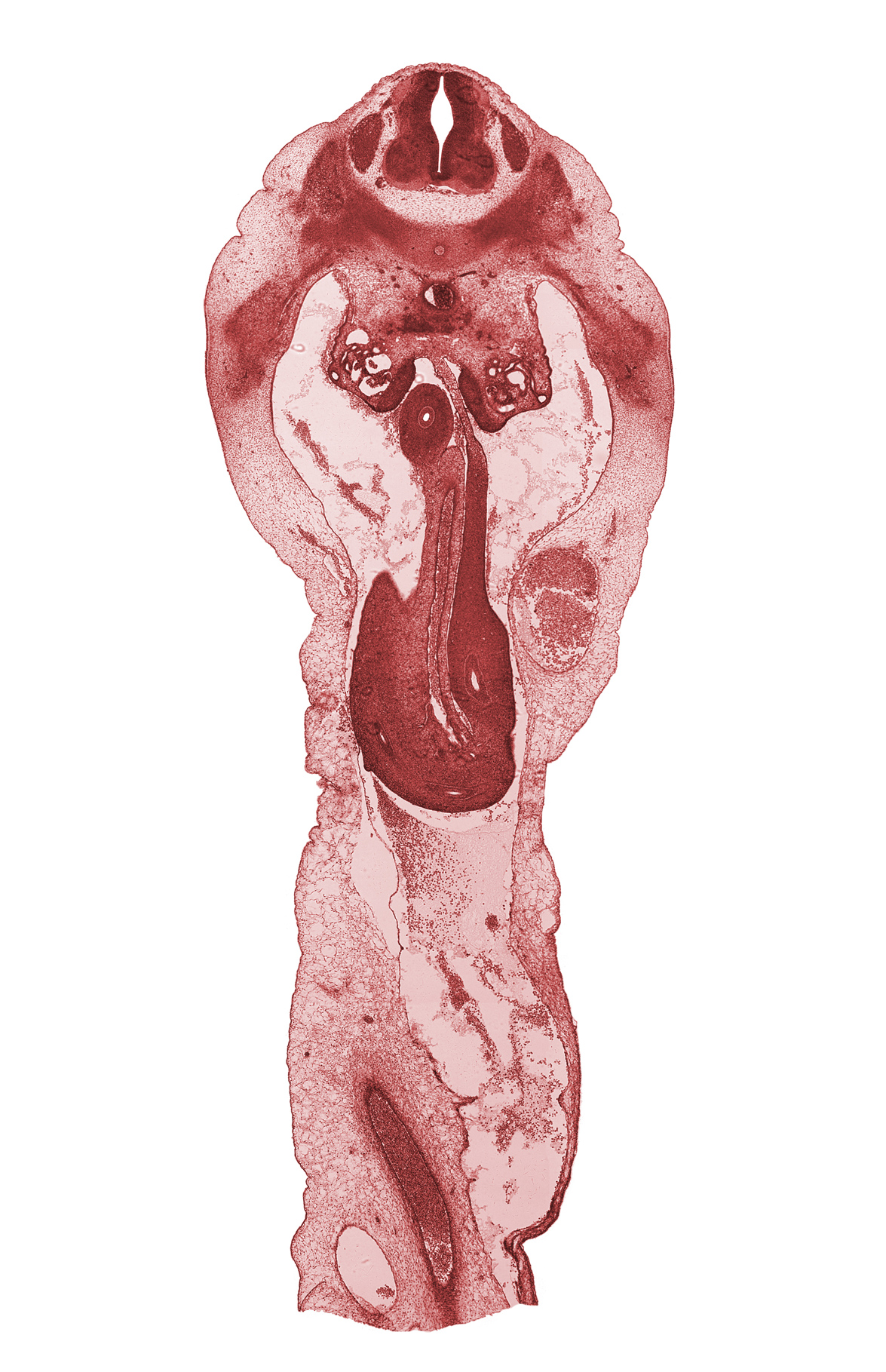 T-12 spinal ganglion, aorta, distal limb of herniated midgut, duodenum, midgut mesentery, proximal limb of herniated midgut, subcostal nerve (T-12), superior mesenteric artery, umbilical vein