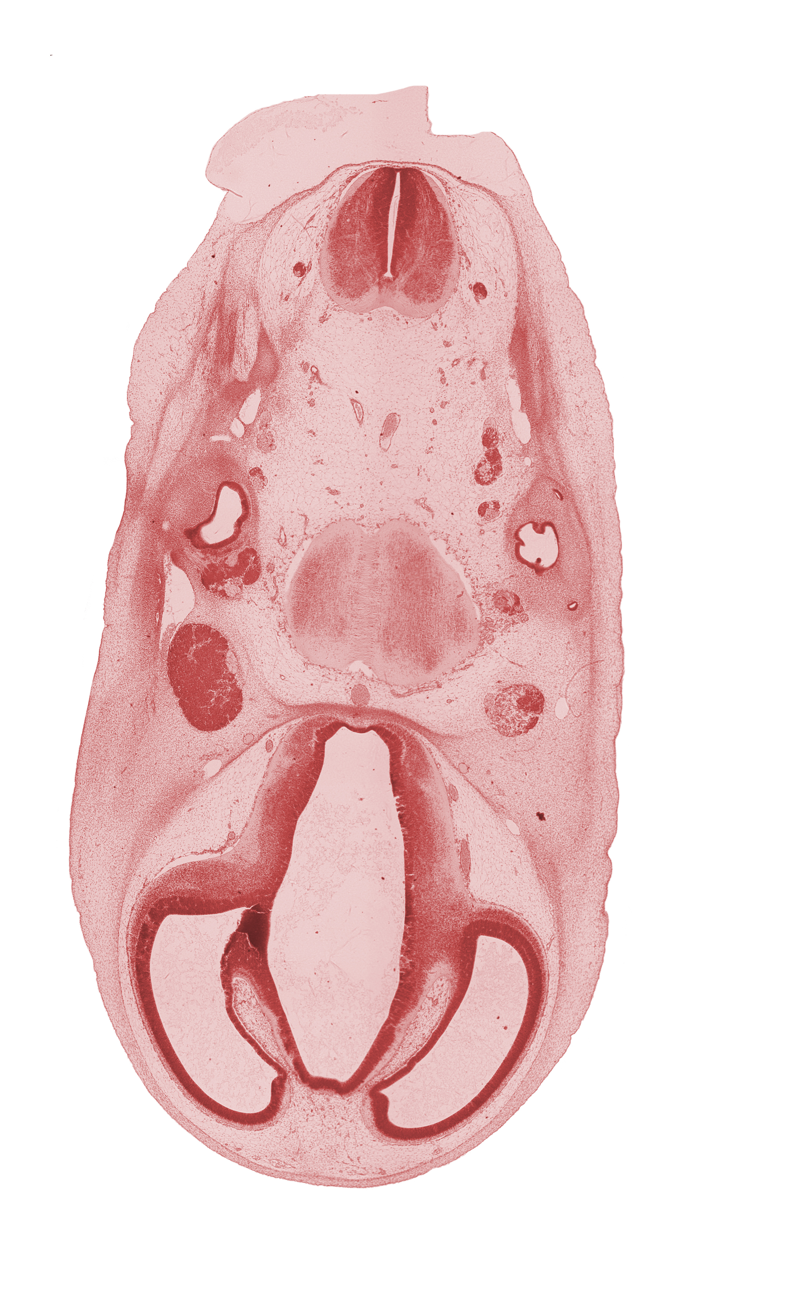 accessory nerve (CN XI), anterior semicircular duct, artifact separation(s), basilar artery, hippocampal thickening, hypothalamus, left vertebral artery, pons region (metencephalon), right vertebral artery, roof of diencephalon, root of abducens nerve (CN VI), root of trigeminal nerve (CN V), spinal accessory nerve (CN XI), subarachnoid space, superior ganglion of glossopharyngeal nerve (CN IX), superior ganglion of vagus nerve (CN X), transition region, trigeminal ganglion (CN V)