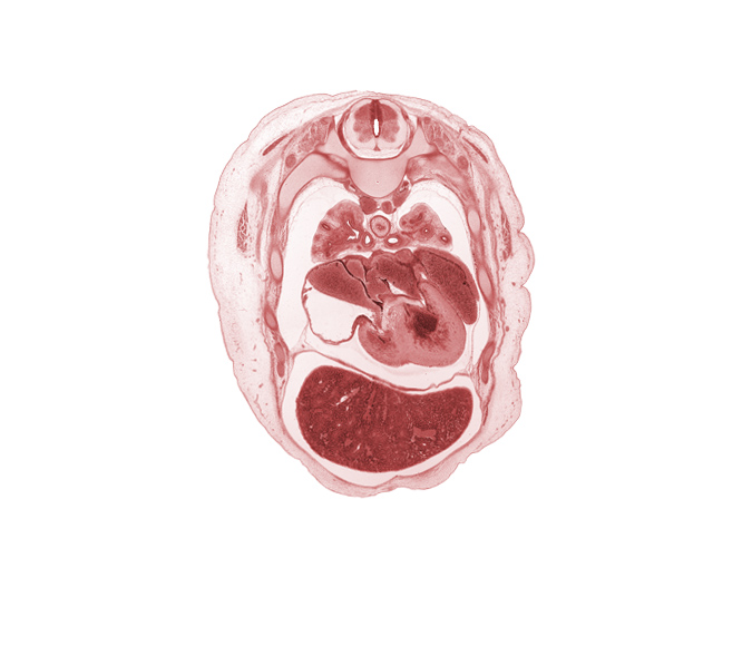 T-3 / T-4 interganglion region, anterior segmental bronchus, apical segmental bronchus, azygos vein, interventricular sulcus, left atrioventricular (mitral) valve, left atrium, left ventricle, muscular part of interventricular septum, phrenic nerve, posterior segmental bronchus, primary bronchus, rib 5, right atrioventricular (tricuspid) valve, right atrium, right ventricle, sinus venosus, superior hemi-azygos vein, upper lobe of left lung, upper lobe of right lung