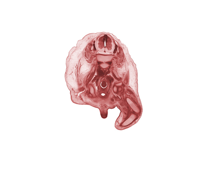 L-3 / L-4 intervertebral disc, L-3 spinal ganglion, L-3 spinal nerve, adductor muscles, external iliac vessels, femoral nerve, femur, gubernaculum of testis, internal iliac vessels, lumbar plexus, notochord, obturator nerve, pubis, scrotal swelling, shaft of penis, sigmoid colon, tibia, urinary bladder
