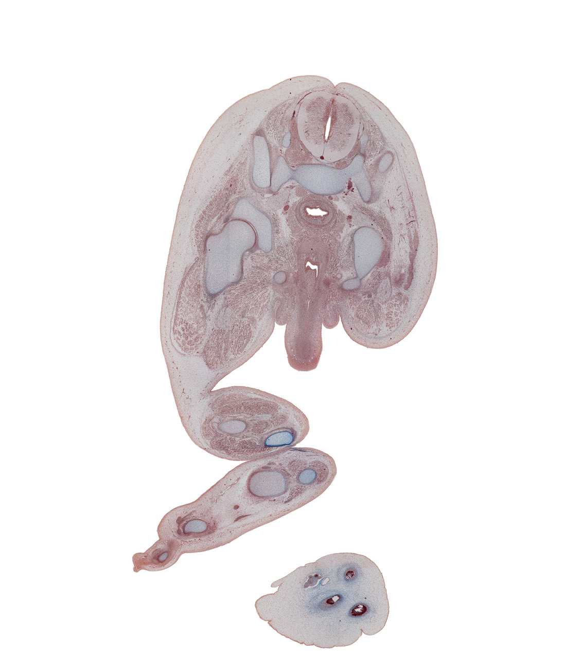 S-1 / S-2 interganglion region, ala of sacrum, anterior spinal artery, calcaneal tendon, corpus spongiosum, dorsal horn of grey matter, extensor digitorum longus tendon, extensor hallucis longus tendon, fibula, fibularis longus and fibularis brevis muscles, flexor digitorum longus tendon, flexor hallucis longus muscle, fused paramesonephric ducts, gluteus medius muscle, greater trochanter of femur, hip joint, ischial tuberosity, ischiopubic ramus, metatarsal 1, penile urethra, penis, phalynx of digit 2 (foot), piriformis muscle, rectum, sacro-iliac joint, sciatic nerve, scrotal swelling, sympathetic trunk, tibia, tibialis anterior tendon, tibialis posterior tendon, vas deferens, ventral horn of grey matter