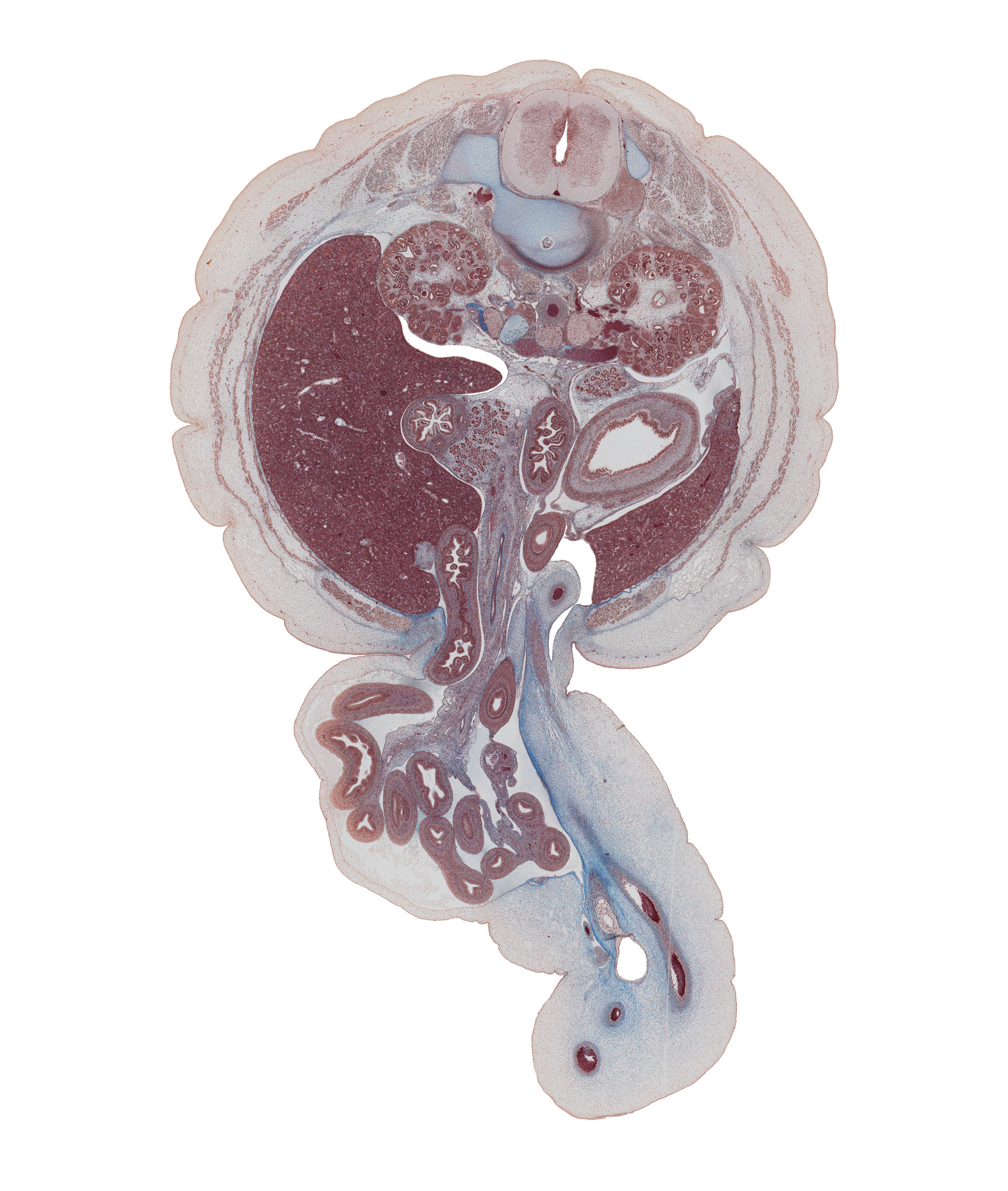 L-1 spinal ganglion, L-1 spinal nerve, allantoic vesicle(s), ascending part of duodenum, caudal edge of gall bladder, colon, descending part of duodenum, extension of umbilical coelom, external abdominal oblique muscle, herniated intestines, inferior vena cava, internal abdominal oblique muscle, jejunum, kidney (metanephros), left umbilical artery, notochord, rectus abdominis muscle, right umbilical artery, spinalis muscle, superior major calyx, suspensory ligament of duodenum, transversospinalis muscle, transversus abdominis muscle, umbilical cord, umbilical vein, umbilical vesicle stalk, urachus