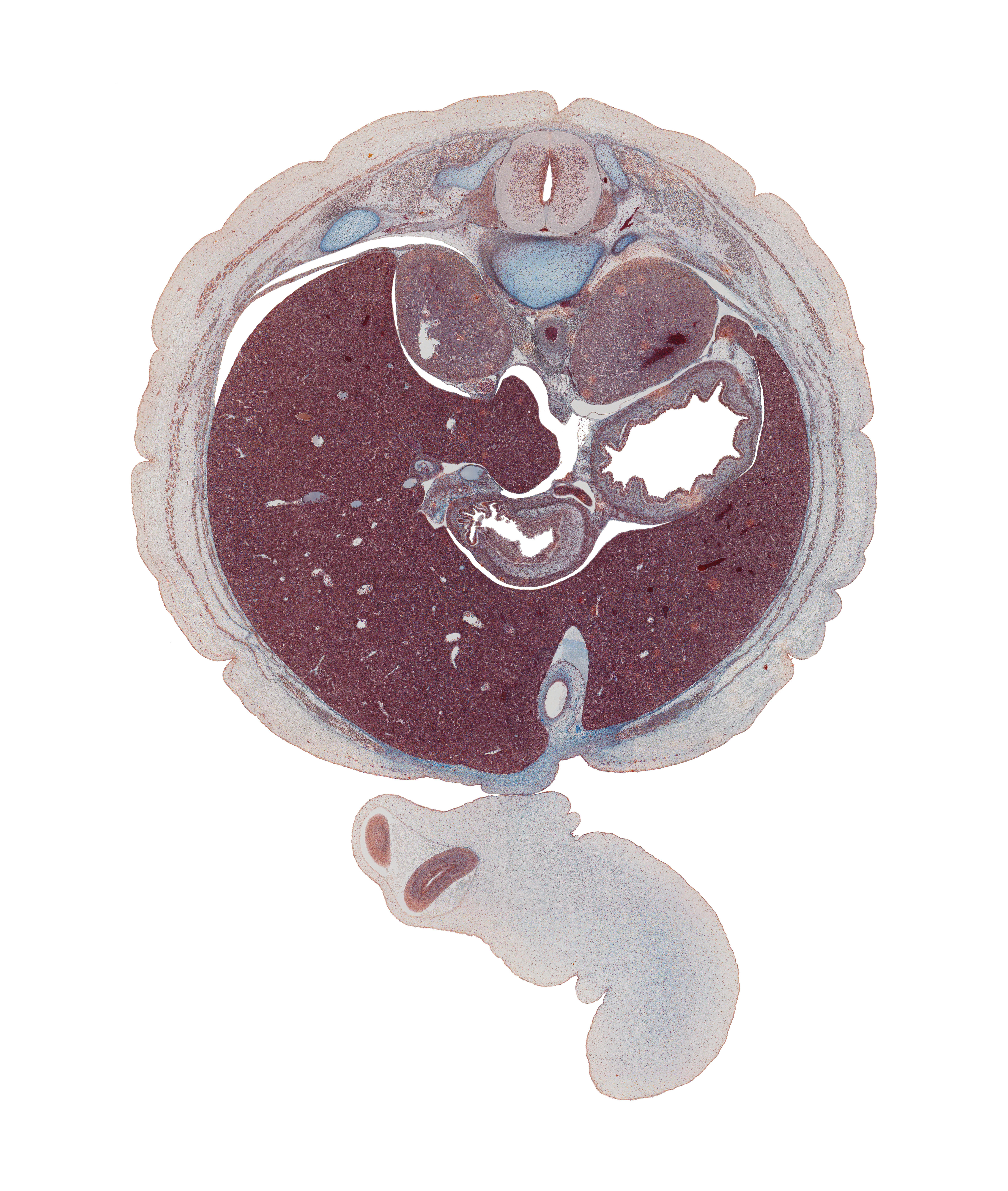 T-11 intercostal nerve, T-11 spinal ganglion, bile duct, dorsal mesogastrium, duodenal ampulla, falciform ligament, head of rib 12, hepatic portal vein, herniated intestines, inferior vena cava, left lobe of liver, lesser curvature of stomach, normal spina bifida occulta, proper hepatic artery, pyloric orifice, pylorus of stomach, rib 11, right lobe of liver, spleen, superior part of duodenum, suprarenal gland cortex, sympathetic trunk, umbilical coelom, umbilical cord, umbilical vein, ventral mesogastrium