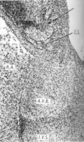 The atrioventricular node is becoming the atrioventricular bundle