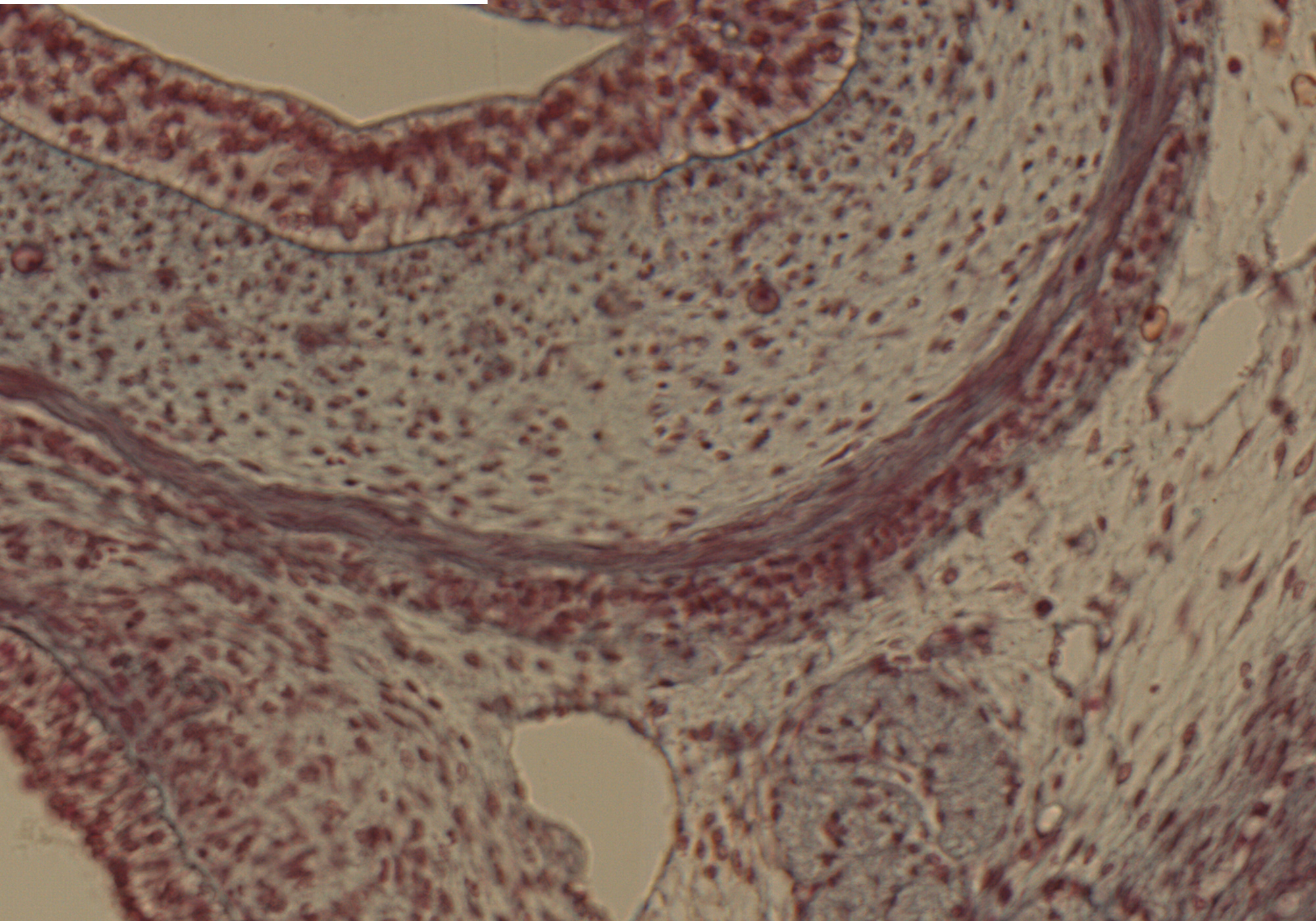 Esophagus Wall in Sup. Mediastinum