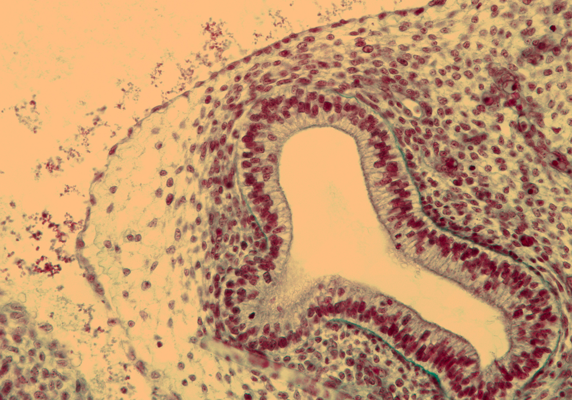 Peripheral Bronchus in Rt. Lung