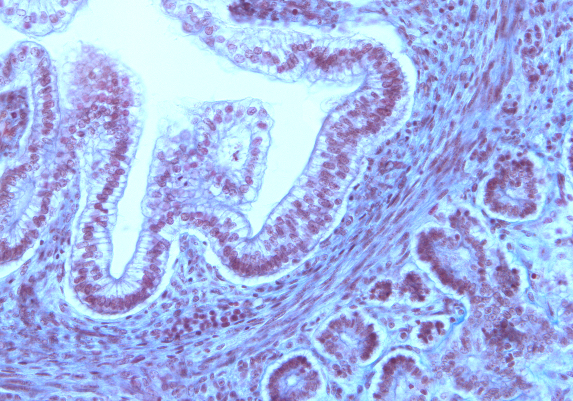 Duodenum Wall and Pancreas Head