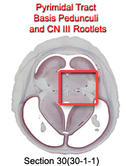 Pyrimidal Tract Basis Pedunculi and CN III Rootlets