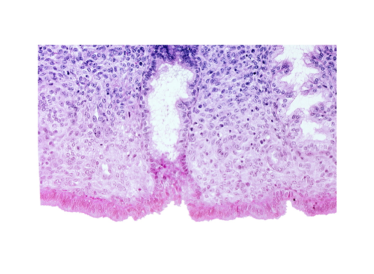 edematous endometrial stroma (decidua), endometrial sinusoid, intact endometrial epithelium