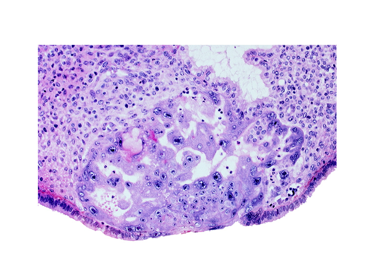 disrupted endometrial epithelium, endometrial gland, intact endometrial epithelium, uterine cavity