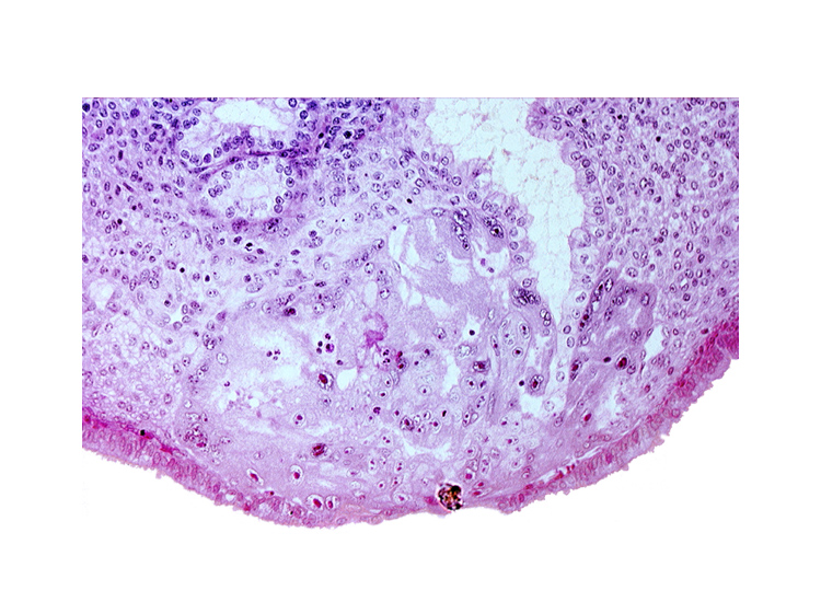 disrupted endometrial epithelium, lumen of endometrial gland, maternal blood cells in lacunae, syncytiotrophoblast, syncytiotrophoblast engulfing endometrial gland cells