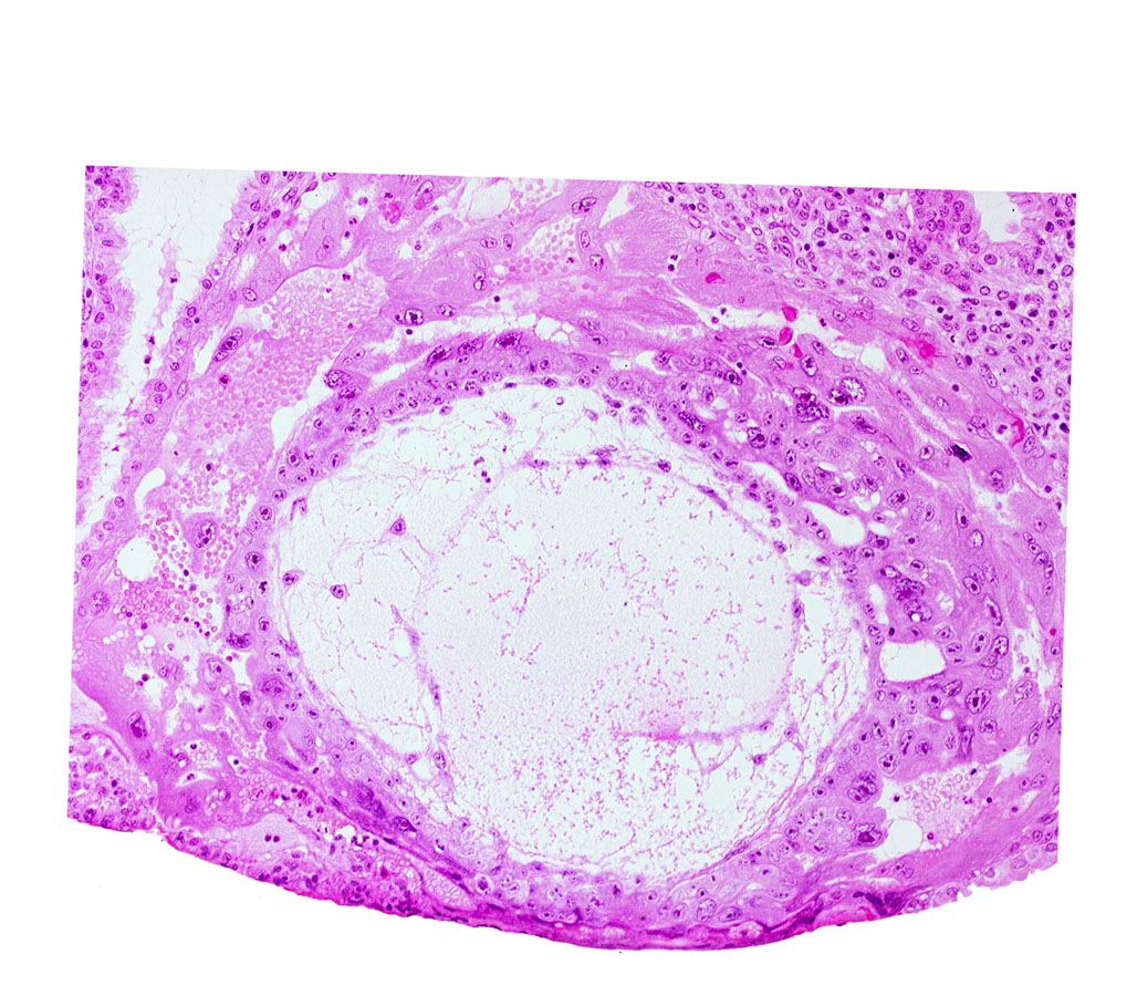 chorionic cavity, disrupted endometrial epithelium, extra-embryonic mesoblast, uterine cavity