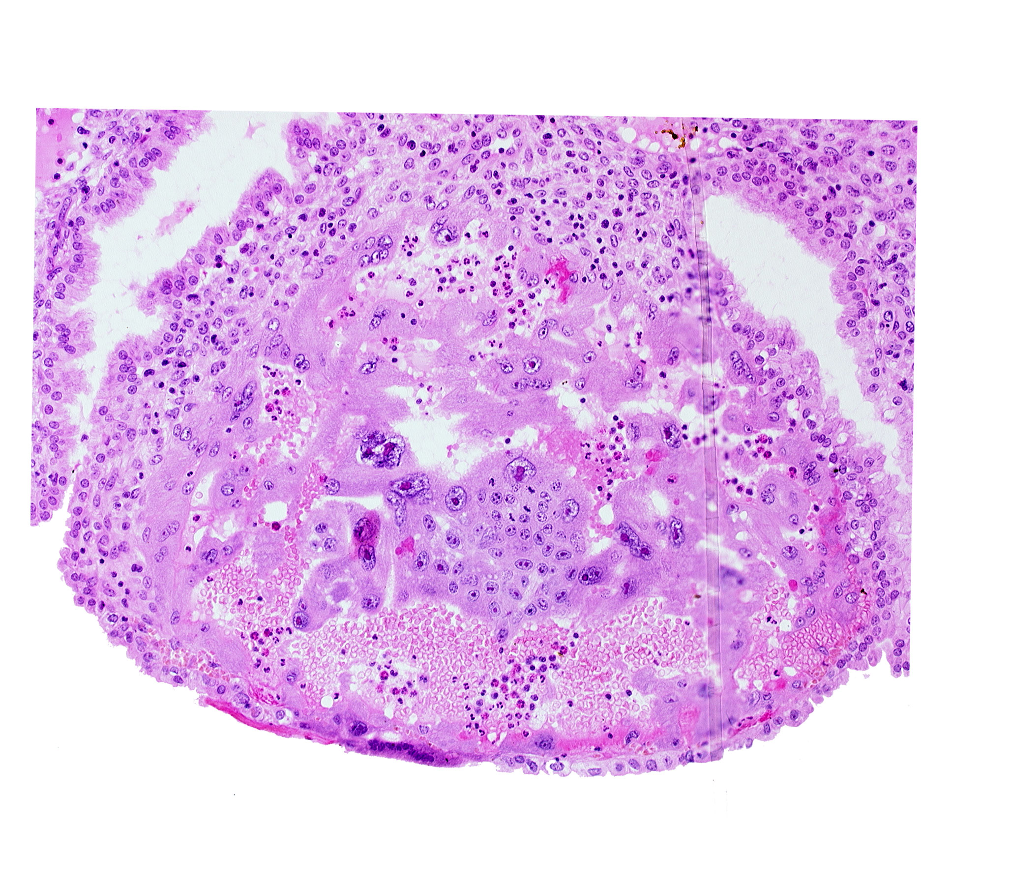 disrupted endometrial epithelium, lumen of endometrial gland, maternal blood cells in trophoblast lacuna