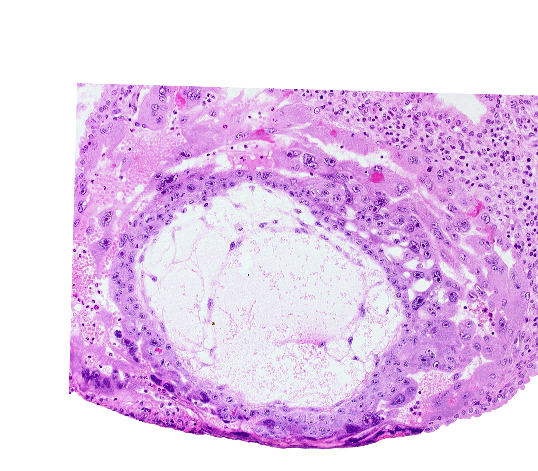 disrupted endometrial epithelium, exocoelomic (Heuser's) membrane, extra-embryonic mesoblast