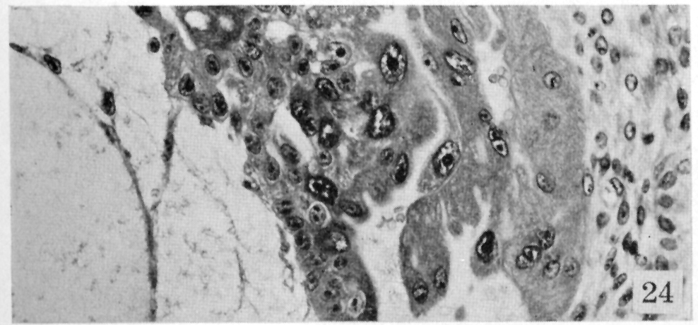 Attachment of trophoblast to exocoelomic (Heuser's) membrane