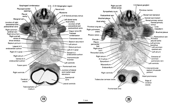 Open PDF version of FIG 6-15, A section through the atrioventricular (AV) region of the heart. A section through the C-6 spinal ganglion and tracheal bifurcation forming primary bronchi.