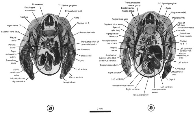 Open PDF version of FIG 7-20, A section through the aortic semilunar valve. A section through the T-3 spinal ganglion and the tracheal bifurcation.
