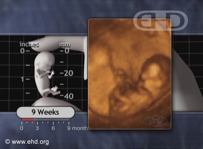 The 9-Week Fetus in Motion [Click for next image]